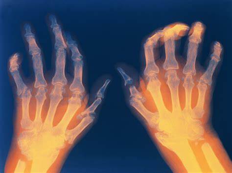 Rheumatoid Arthritis Drugs Market Size & Market Analysis