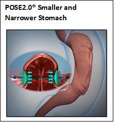 POSE2.0® Smaller and Narrower Stomach